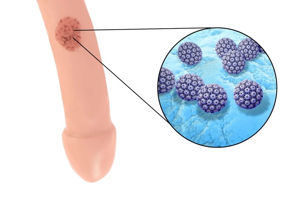 Половой герпес на головке фото HPV Symptoms, Treatment, Vaccine, HPV in Men and Women