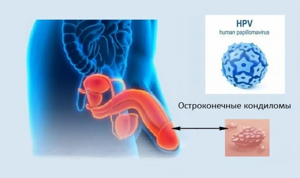 Половой герпес на головке фото Кондиломы у мужчин: фото, на головке, начальная стадия