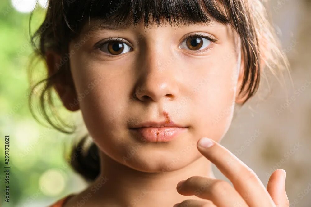 Половой герпес у детей фото Herpes on upper lip of little girl. Child with cold sores on her lips. фотографи