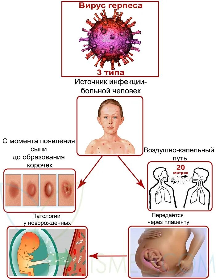 Половой герпес у детей фото Ветрянка. Причины, симптомы и признаки, диагностика и лечение болезни :: Polisme