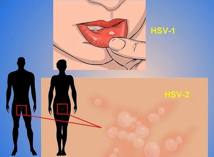 Половой герпес у мужчин фото Половой герпес