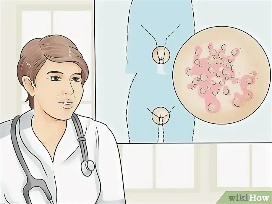 Половой герпес у женщин фото Deinem Partner sagen, dass du Herpes hast: 12 Schritte (mit Bildern) - wikiHow