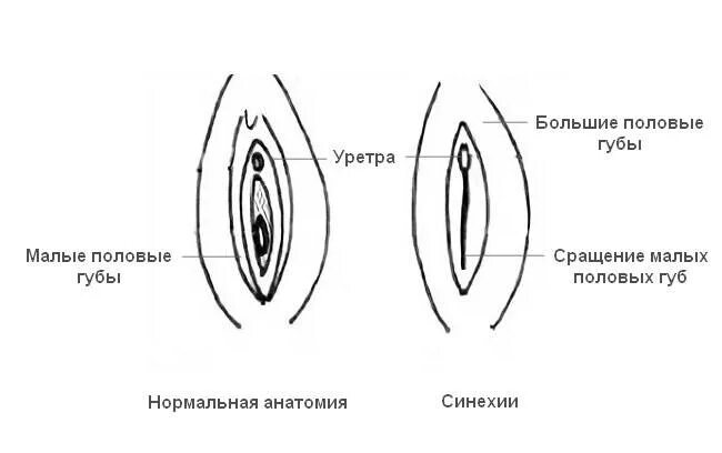 Половые губы фото до и после Синехии у детей: виды, причины, 5 степеней тяжести, внутриматочные синехии