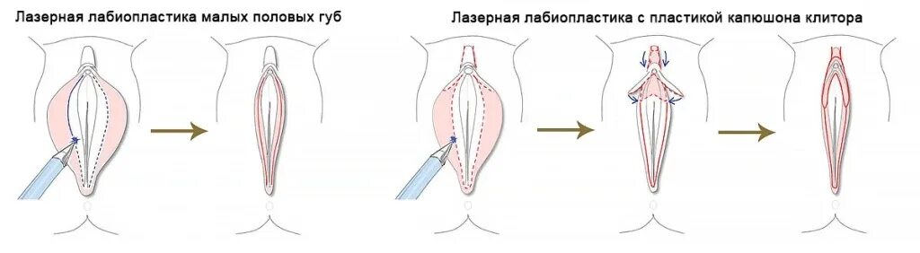 Половые губы фото до и после Интимная пластика (лабиопластика) интервью от Эс Класс Клиник Ульяновск