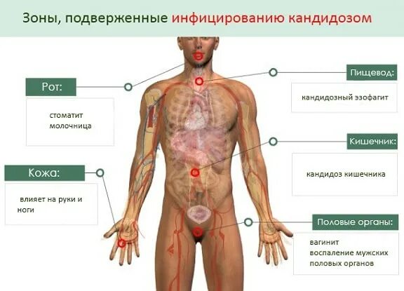 Половые инфекции у мужчин симптомы фото Можно ли забеременеть при кандидозе: особенности процесса