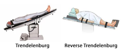Положение тренделенбурга что это такое фото Тренделенбурга положение - Olphoto.ru