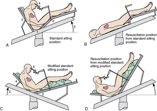 Положение тренделенбурга что это такое фото Anesthetic and Intensive Care Management of the Patient with a Meningioma Clinic