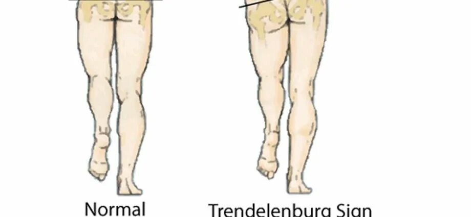 Положение тренделенбурга что это такое фото Trendelenburg symptom - causes, symptoms, treatment - Healthy Food Near Me