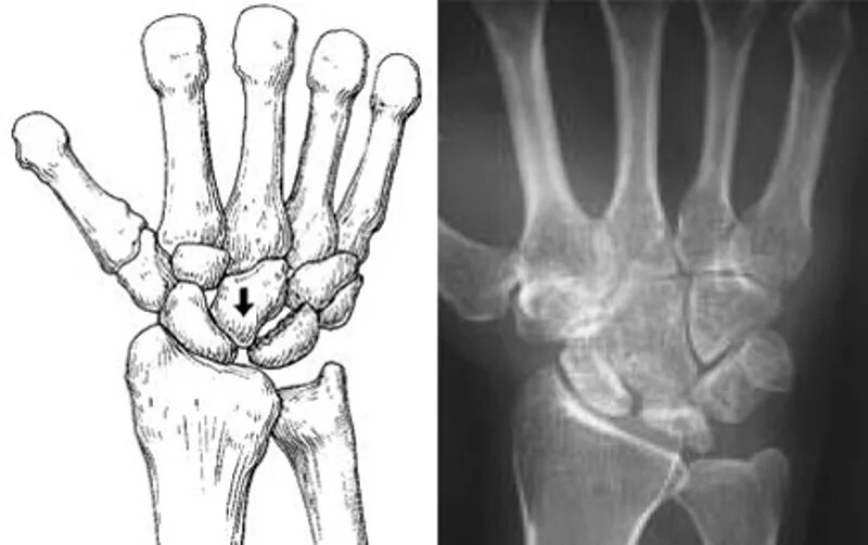 Полулунная кость фото Болезнь Кинбека: симптомы, диагностика, варианты лечения, послеоперационный пери
