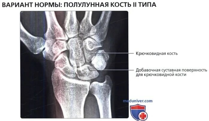 Полулунная кость фото Варианты нормы запястья на рентгенограмме, МРТ