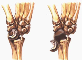 Полулунная кость фото Лучезапястный вывих