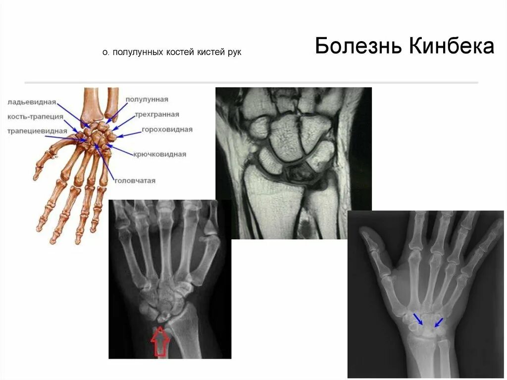 Полулунная кость кисти фото Болезнь Кинбека или некроз полулунной кости у взрослых стадии, симптомы