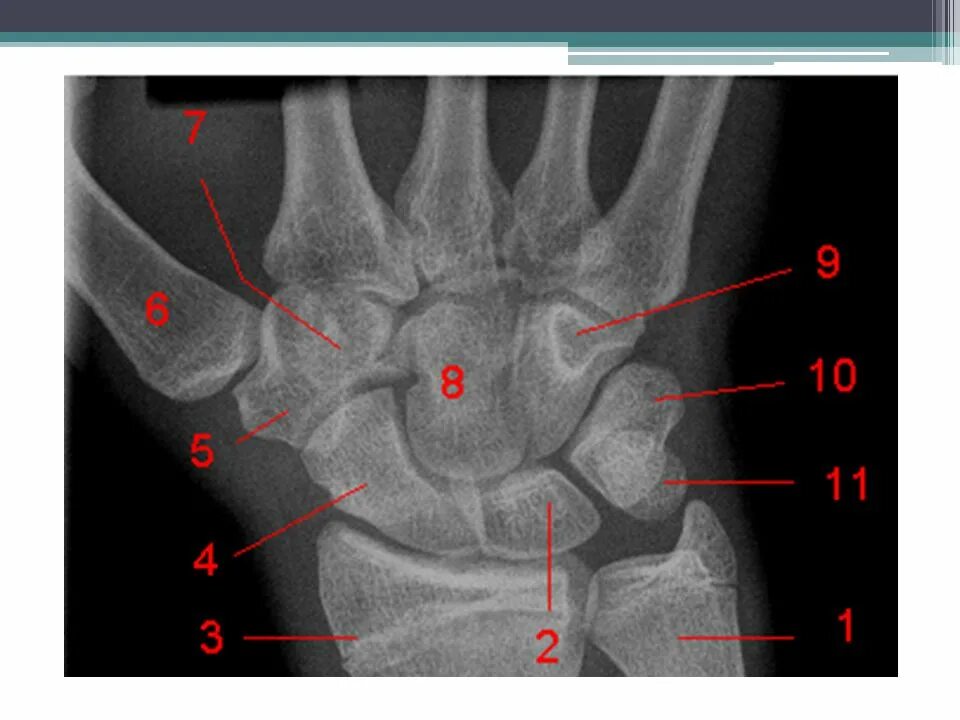 Полулунная кость кисти фото OSTEOLOGIA DO MS Escápula Clavícula Úmero Rádio Ulna - ppt carregar