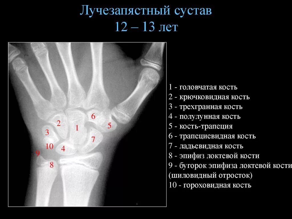 Полулунная кость запястья фото Кости 2 13: найдено 89 изображений