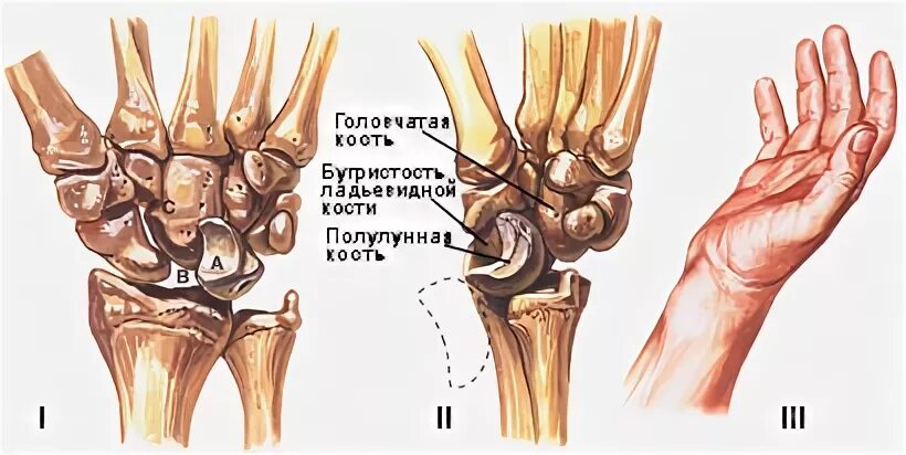Полулунная кость запястья фото Вывихи костей запястья Спортивная медицина
