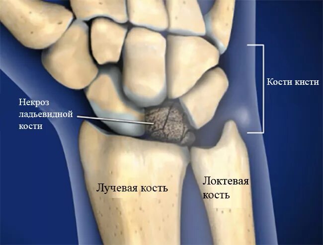 Полулунная кость запястья фото Болезнь Кинбека: признаки, диагностика и методы лечения Все о суставах и связках