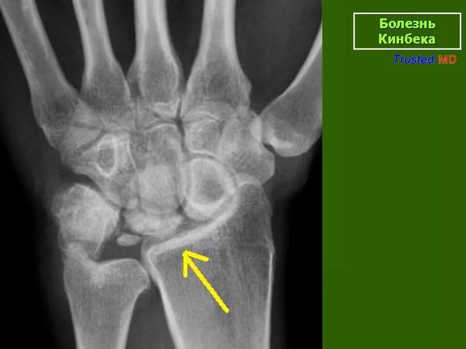 Полулунная кость запястья фото Остеохондропатия. Остеохондропатия полулунной кости кисти (болезнь Кинбека). + П
