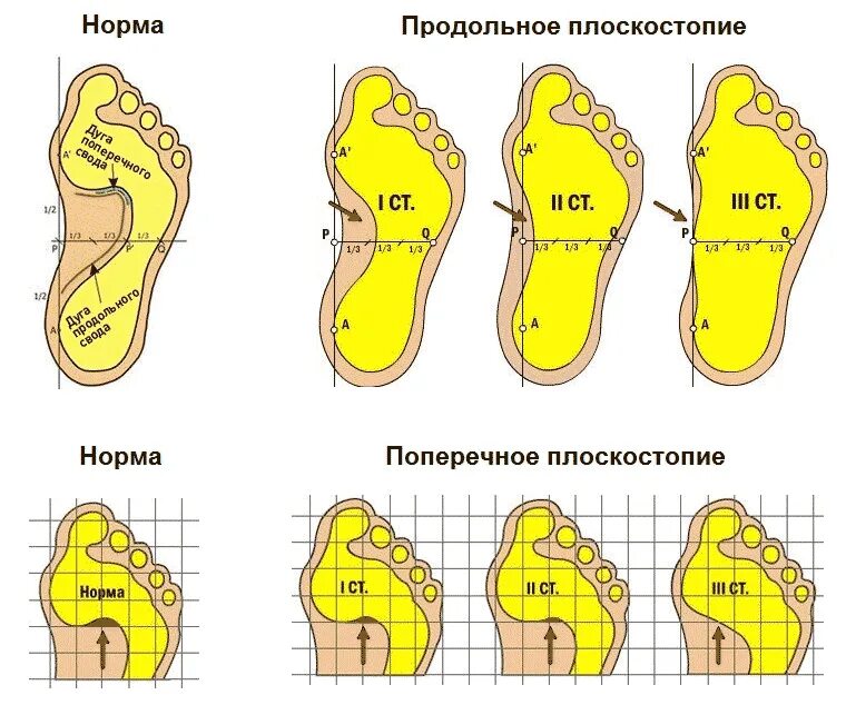 Поперечное плоскостопие симптомы фото Что вызывает и как исправить деформацию стопы у ребенка?