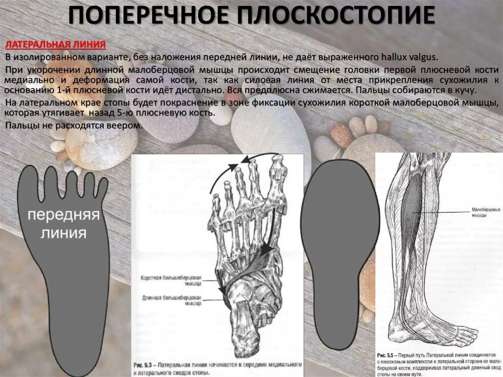 Поперечное плоскостопие симптомы фото Поперечное плоскостопие. Как предотвратить?