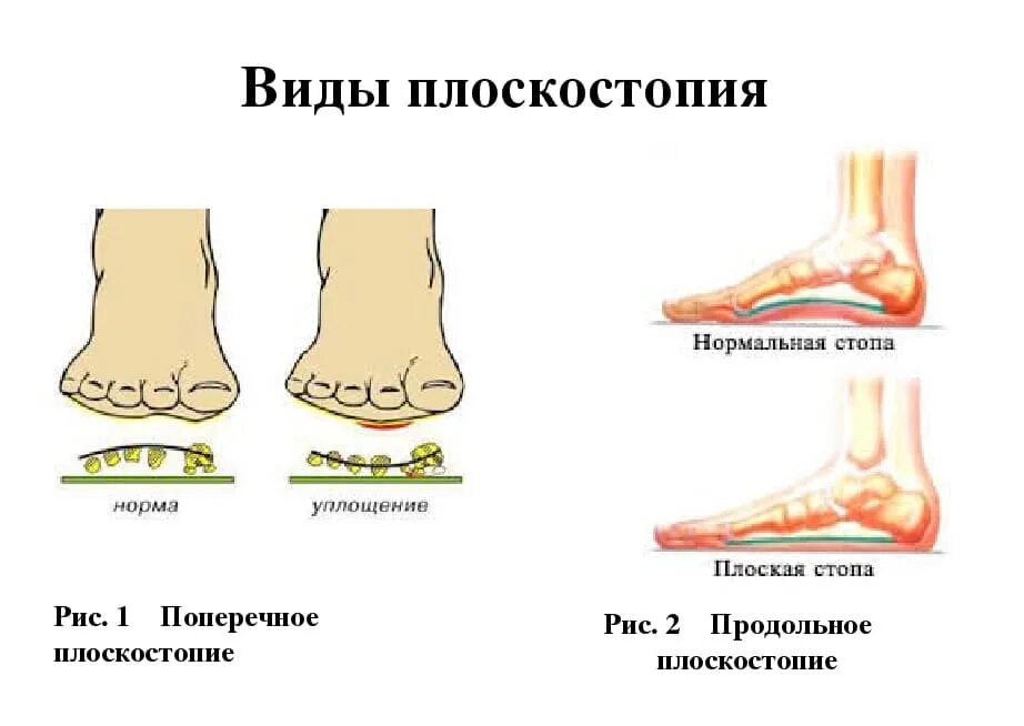 Поперечное плоскостопие симптомы фото Плоскостопие - виды, симптомы и лечение в Центре остеопатии