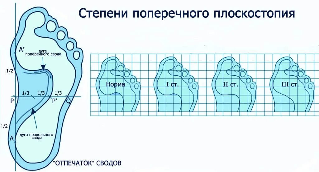 Плоскостопие: причины, симптомы, лечение Клиника доктора Трубникова Дзен