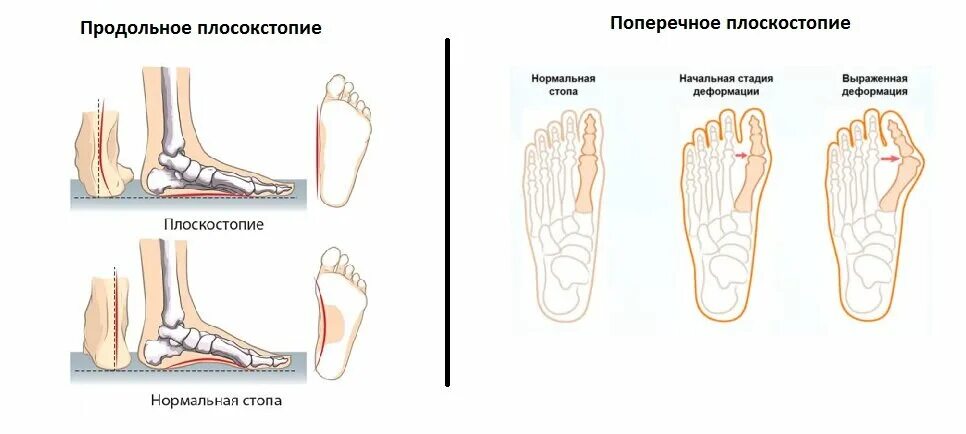 Поперечное плоскостопие симптомы фото Плоскостопие: причины, симптомы, лечение Клиника доктора Трубникова Дзен