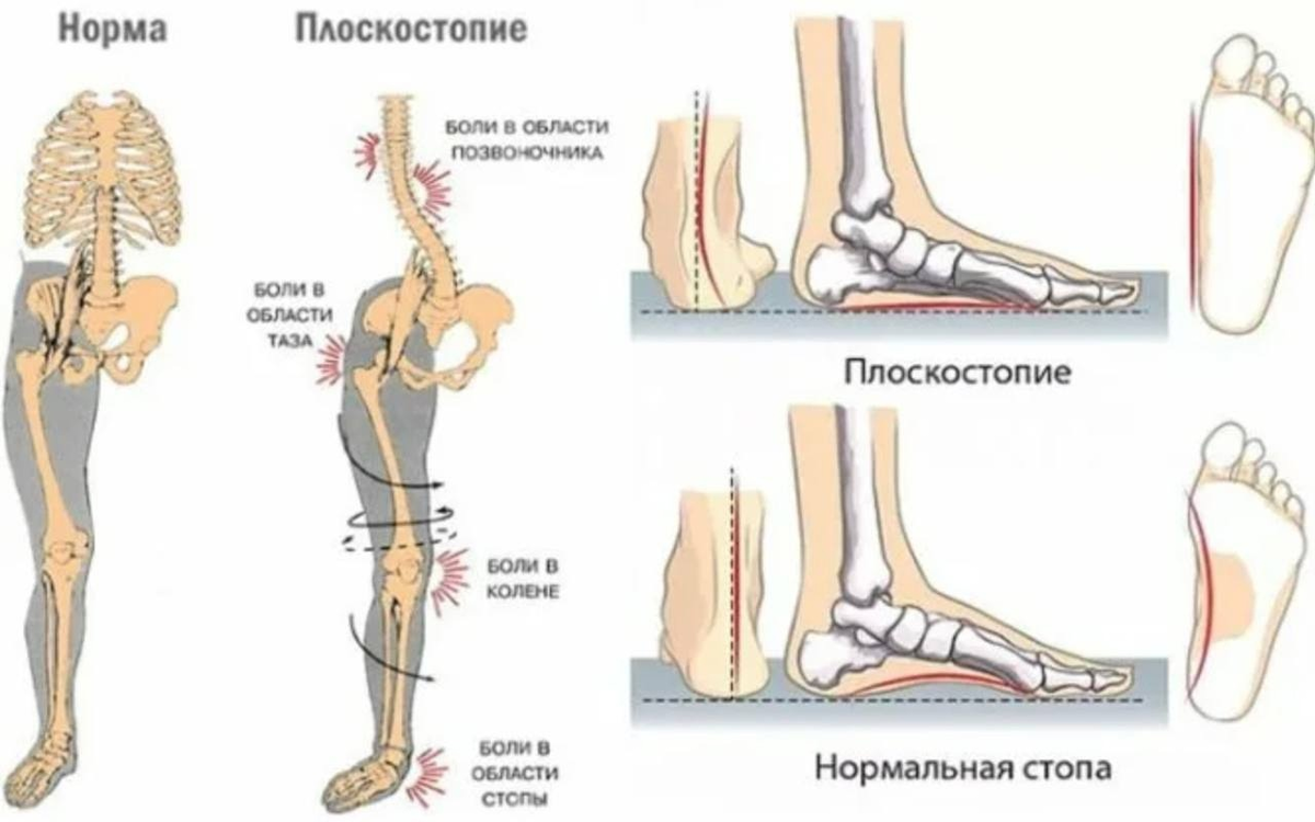 Поперечное плоскостопие симптомы фото Сам Себе Ортопед: суть метода работы с плоскостопием Сам Себе Ортопед. Спб. Дзен