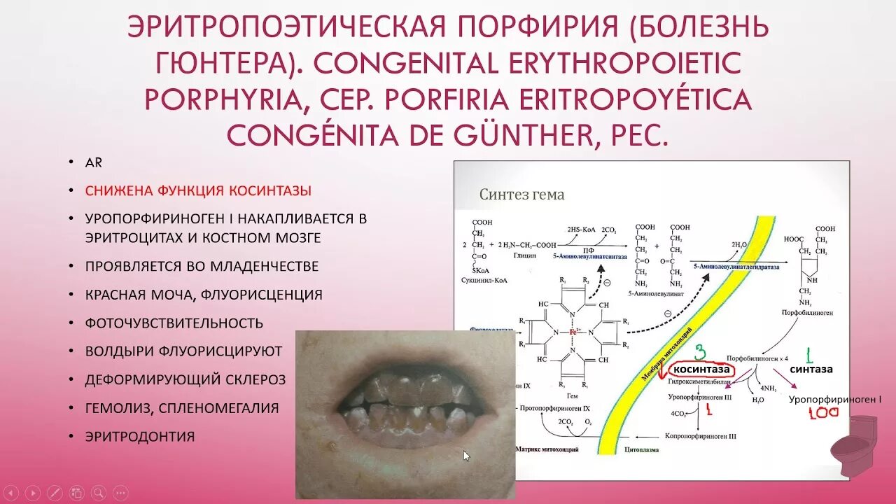 Порфирия симптомы фото 4 Эритропоэтическая порфирия , болезнь Гюнтера (Günther). Congenital erythropoie