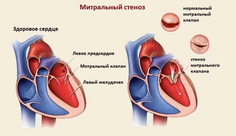 Порок сердца фото Lecture Nursing care for aortic valve defects