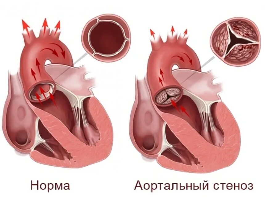 Порок сердца фото Новости и статьи от производителя медтехники "Новоком"