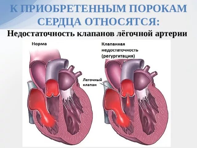 Порок сердца фото Сестринский уход при ревматизме, пороках сердца