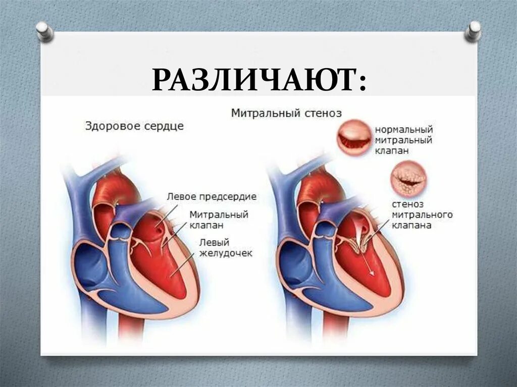 Порок сердца фото Митральные и аортальные пороки сердца: найдено 88 изображений