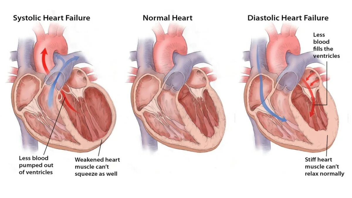 Порок сердца фото Diastolic heart failure - Isaac's science blog