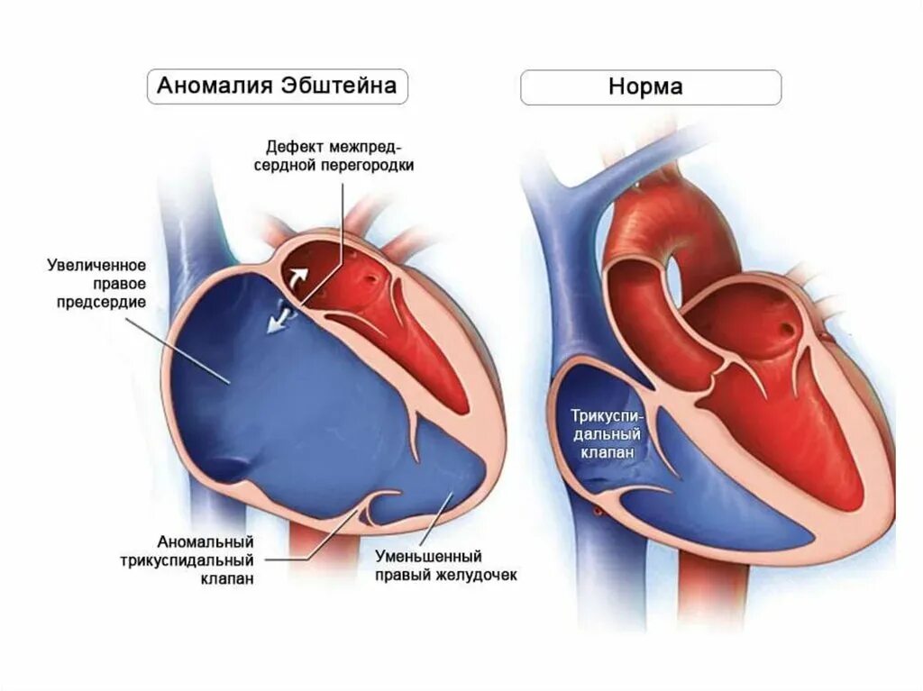 Порок сердца фото Аномалия Эбштейна - чем такой порок сердца грозит ребенку? О детском здоровье: с