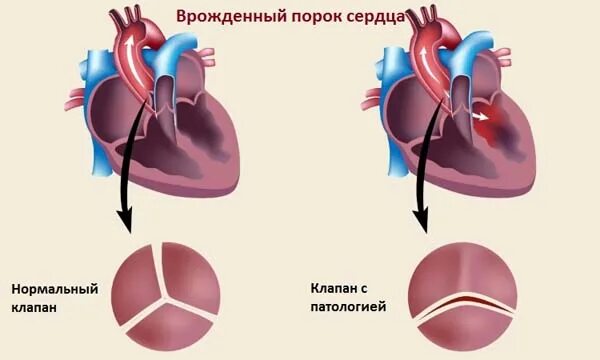 Порок сердца фото Врожденный порок сердца у детей новорожденных операция лечение