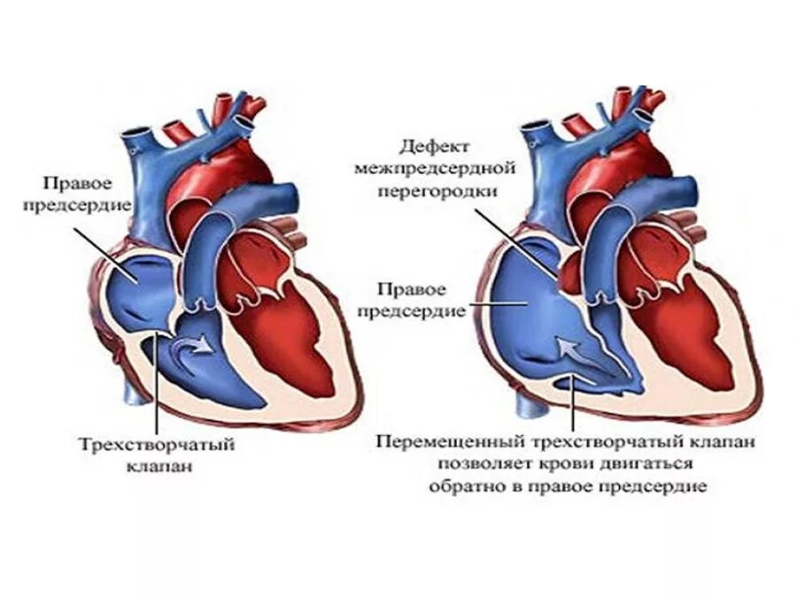 Порок сердца фото Ангиокардиографическая диагностика дефектов аортолегочной перегородки Golos Blog