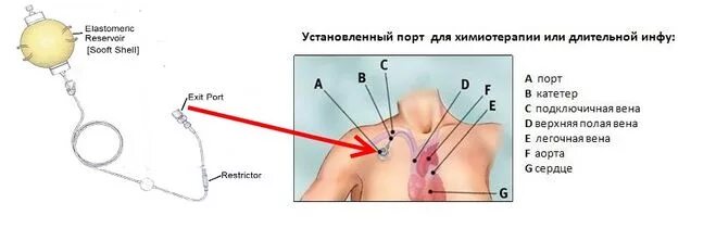 Порт система для химиотерапии фото Где промыть порт систему: найдено 77 картинок