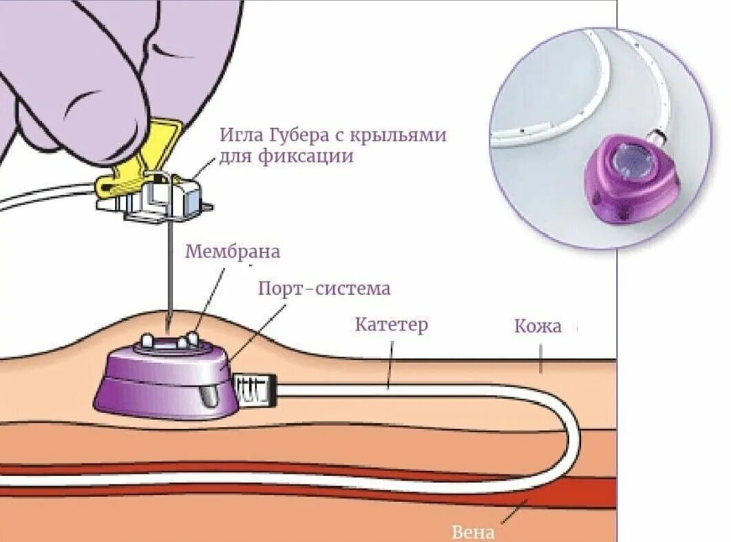 Порт система для химиотерапии фото Как облегчить процесс химиотерапии? Онколог Базылев Дзен