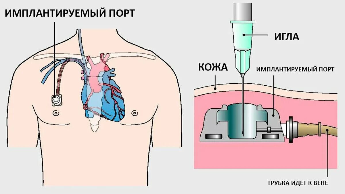 Порт система для химиотерапии цена фото Трижды негативный рмж : порт - система Трижды Негативный РМЖ Дзен