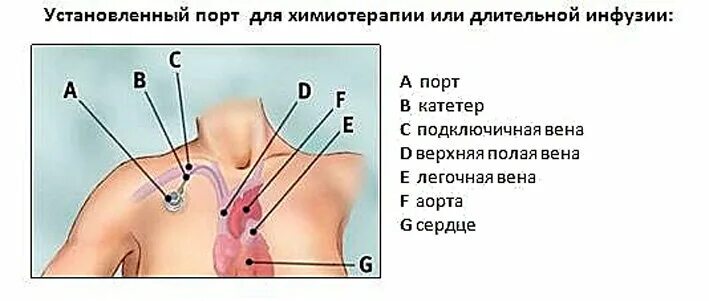 Порт система для химиотерапии цена фото Порт система что это такое