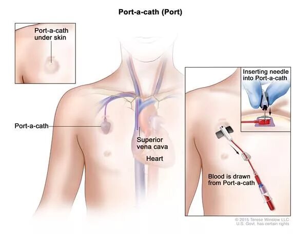 Порт система для химиотерапии цена фото Pin on Nursing Injections, IVs, & VADs Oncology nursing, Oncology, Nurse