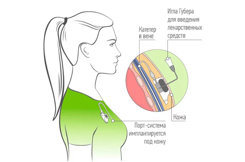 Порт система для химиотерапии установка фото Иглы Губера для порт-систем: виды и отличия ☝ инструкция использования
