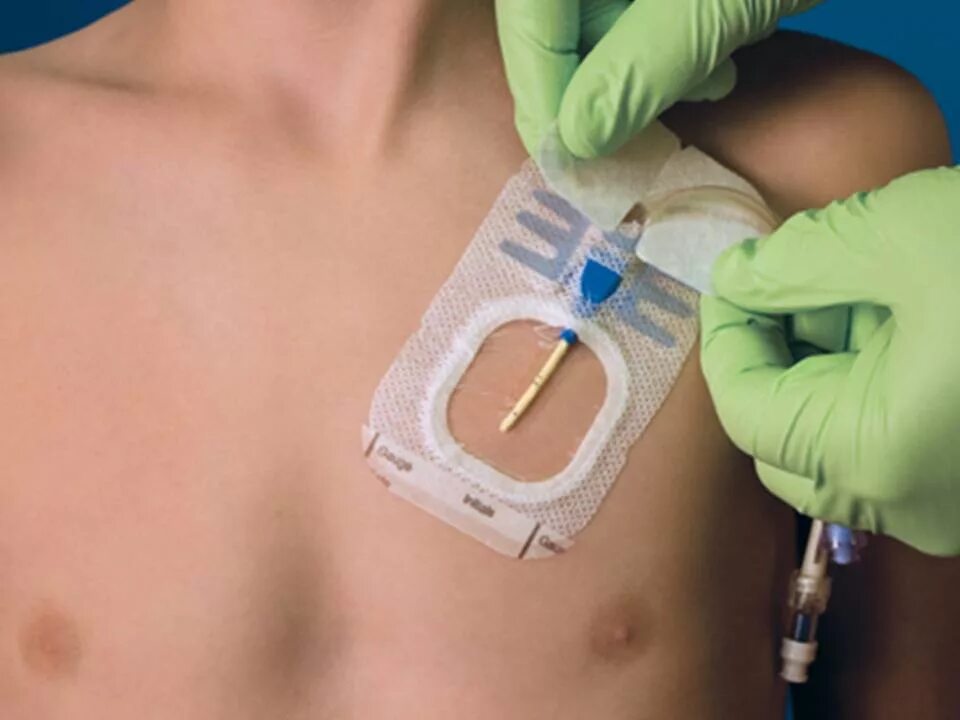 Порт система фото Tube For Intravenous Fluids Injections To Implantable Port For, chemotherapy por