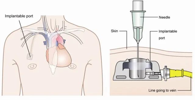 Порт система фото Port A Cath Anatomy - On Haircuts