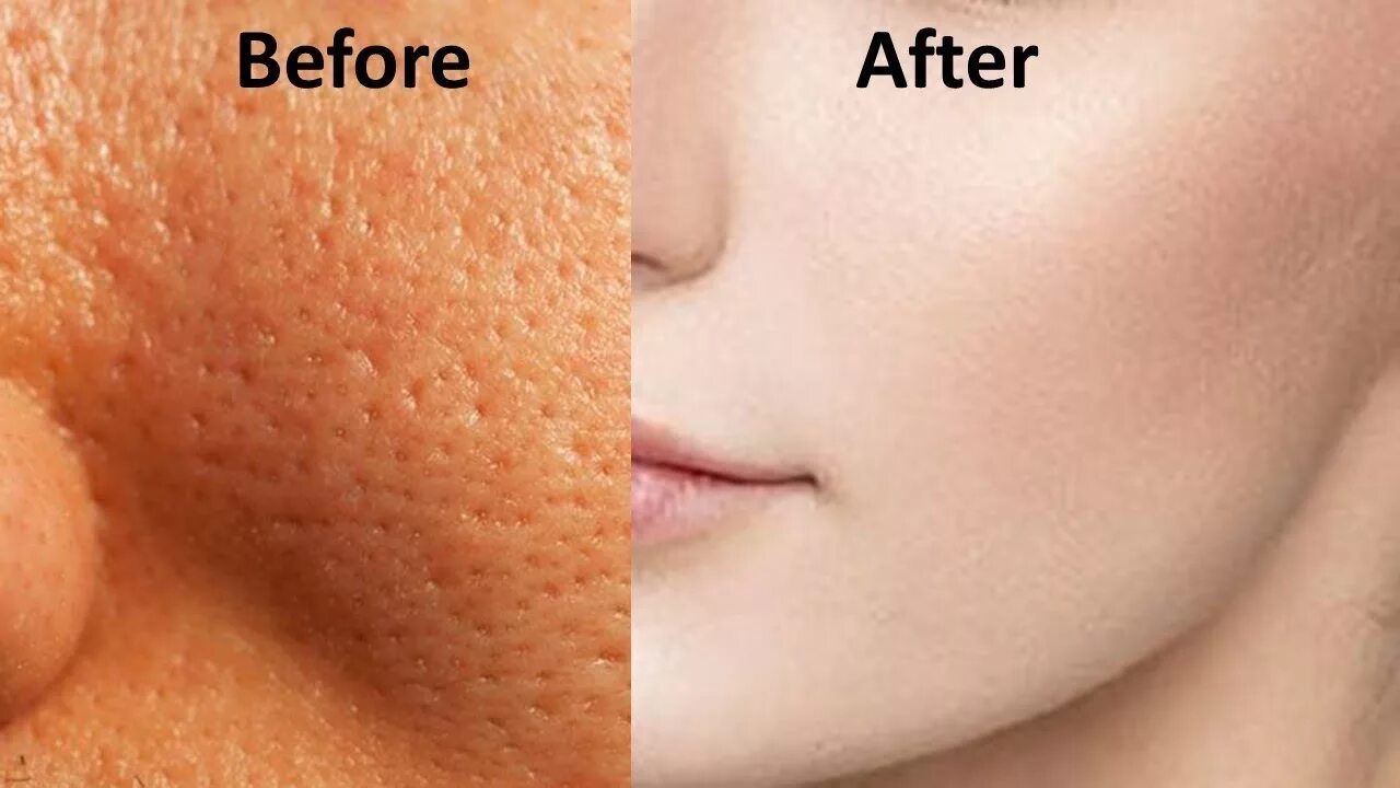 Поры на лице фото How to Get Rid Of Open Pores On Skin Permanently in One Day - YouTube