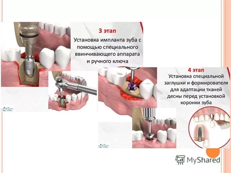 Порядок установки имплантантов зубов пошагово с фото Схема установки импланта зуба