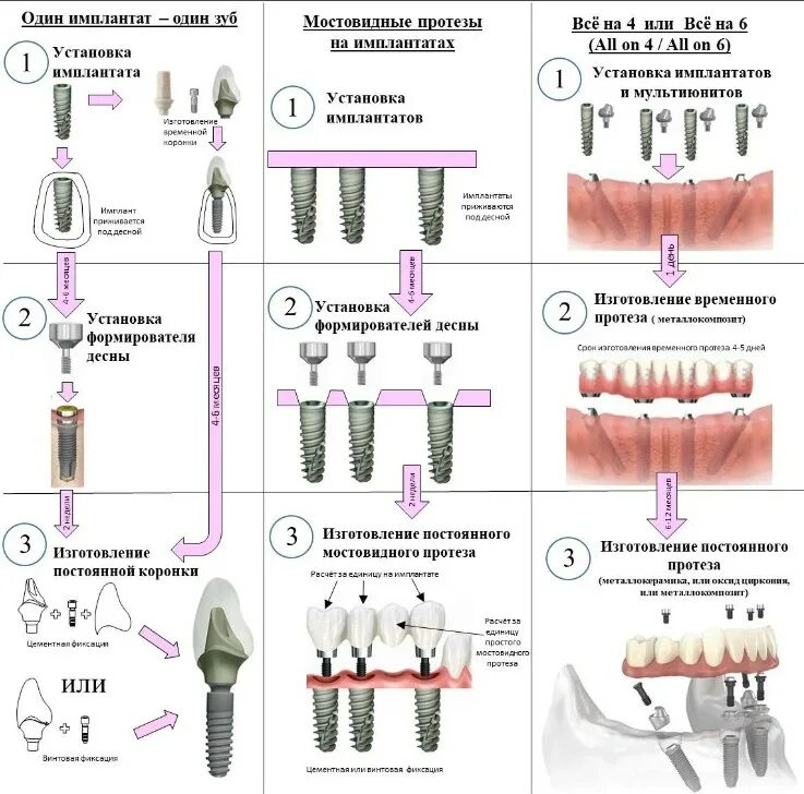 Порядок установки имплантантов зубов пошагово с фото Виды имплантации в стоматологии Мирана Дент в Москве