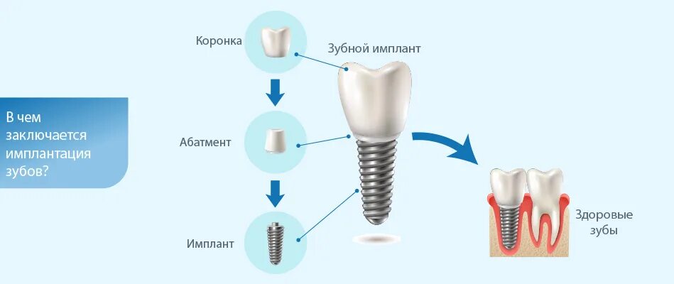 Порядок установки имплантантов зубов пошагово с фото Анализы для имплантации