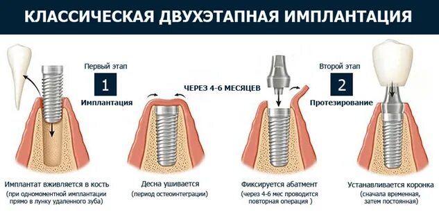 Порядок установки имплантантов зубов пошагово с фото Кому подходит имплантация зубов. Её плюсы.