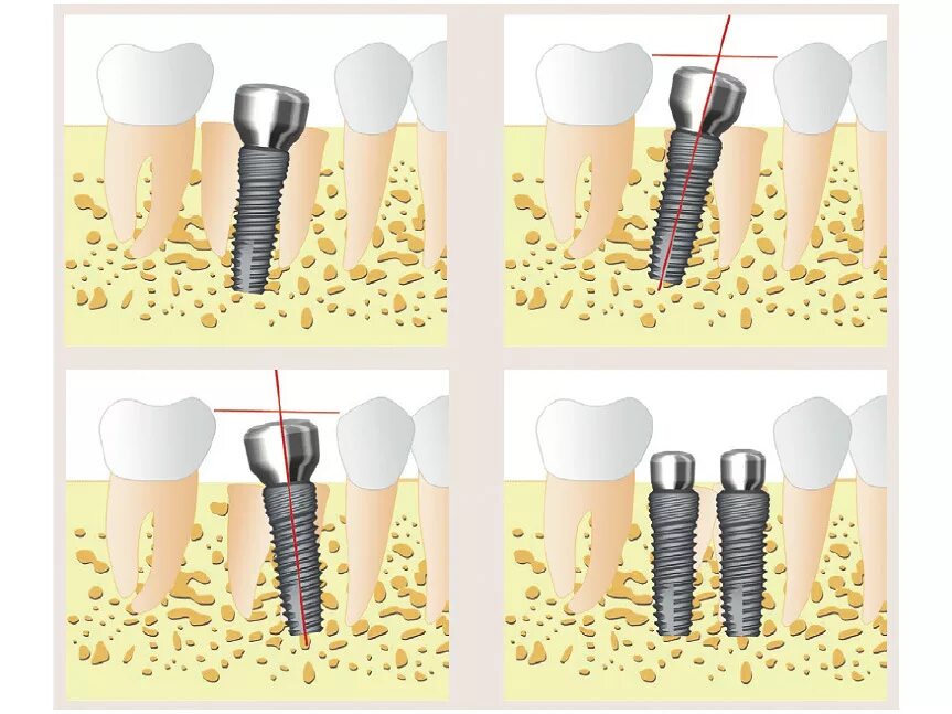 Порядок установки имплантантов зубов пошагово с фото Установка имплантата сразу после удаления моляра на нижней челюсти - DENTALMAGAZ